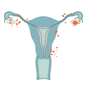 Endométriose face