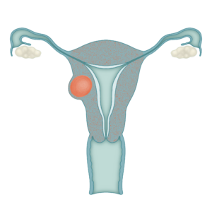 Fibrome utérin